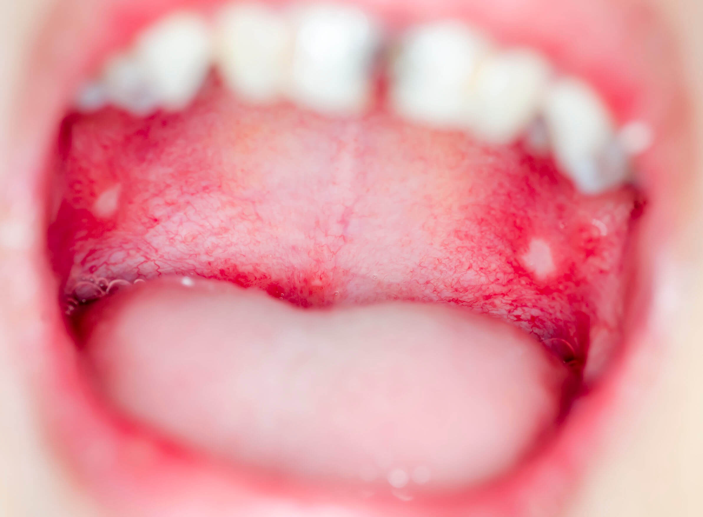 舌头下长肉芽怎么回事,正常舌头底下肉芽图片 - 伤感说说吧