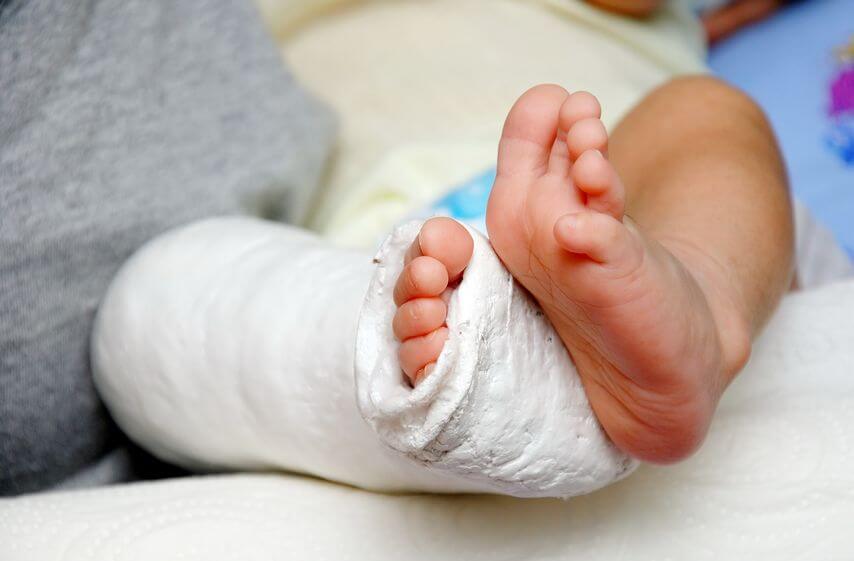 赤ちゃんに起こる足の病気 先天性内反足と外反踵足とは 症状や原因や治療法